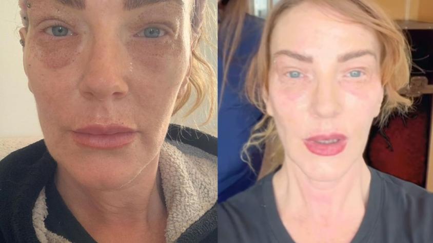 Catalina Pulido mostró la evolución del procedimiento estético al que se sometió por "razones médicas"