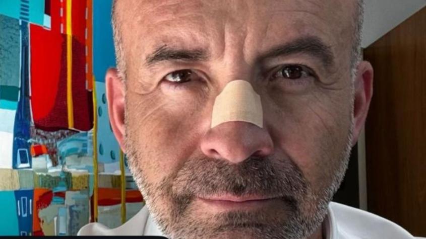 "Estoy recogiendo mi dignidad": Abogado Claudio Valdivia cuenta la verdad del parche que tiene en la nariz