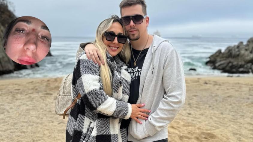 La única buena noticia que dejó accidente de la polola de Nano Calderón: influencer cumplirá un sueño