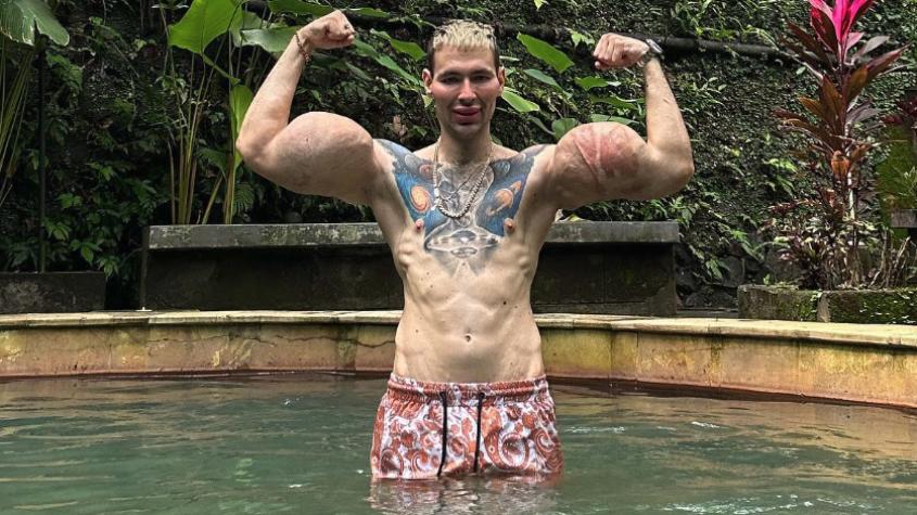 El drama del “Popeye ruso”: se inyectó aceite en los bíceps y ahora arriesga amputación