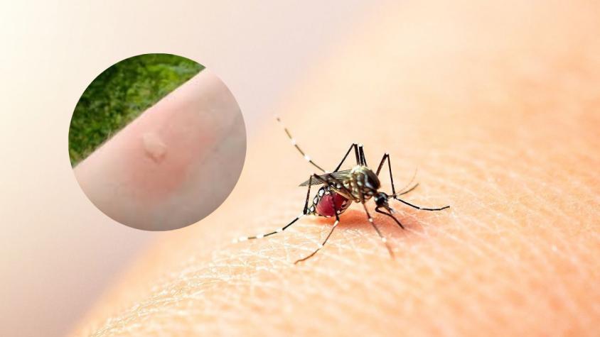 No solo dengue: los síntomas que provoca la picadura del mosquito que transmite zika
