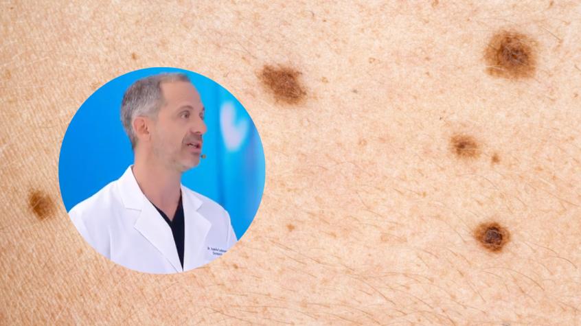 ¿Mancha sospechosa? Dermatólogo revela cuándo podría tratarse de cáncer de piel
