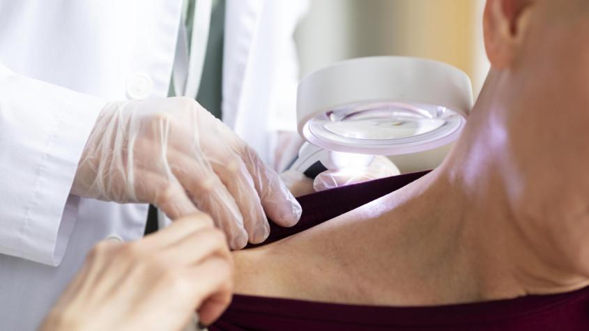 Chequeos gratuitos de lunares en Reñaca: el 90% de los casos de cáncer de piel son curables si se detectan a tiempo