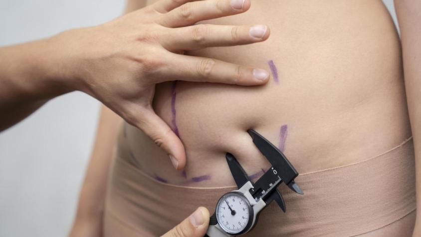 Bono PAD Manga Gástrica 2026: cuál es el valor de la cirugía bariátrica por Fonasa