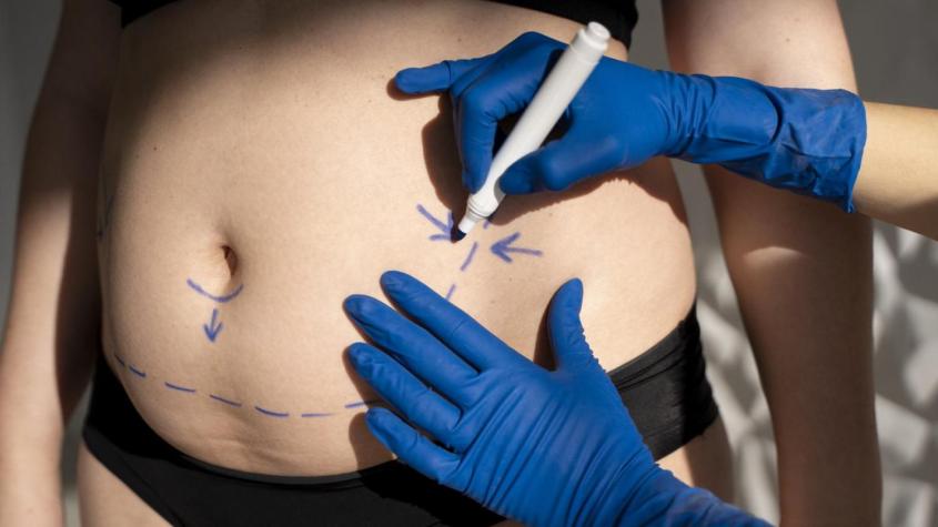 Abdominoplastia con Bono PAD: revisa el valor que debe pagar el paciente de la cirugía Abdominoplastia con Bono PAD: revisa el valor que debe pagar el paciente de la cirugía