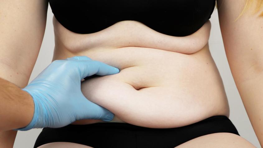 Abdominoplastía con Bono PAD: así puedes pagar solo $268.770 al momento de la cirugía Abdominoplastía con Bono PAD: así puedes pagar solo $268.770 al momento de la cirugía