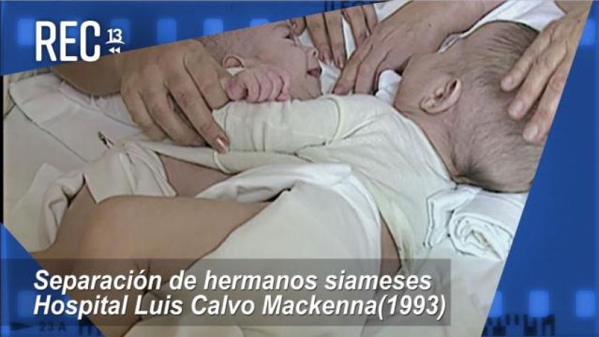 #MomentosREC: Separación de hermanos siameses (1993)